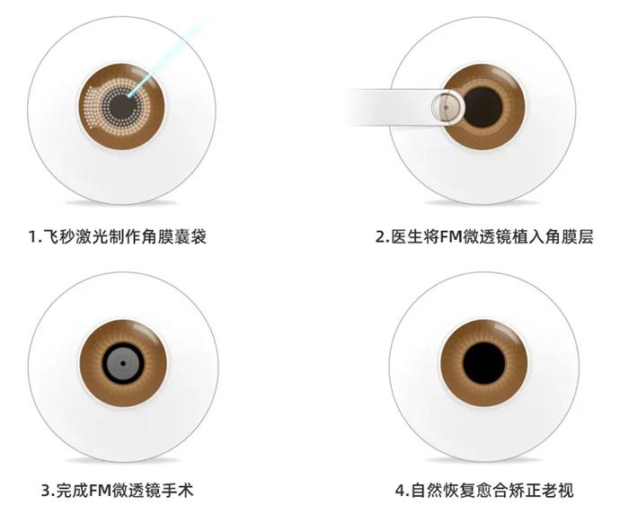 厦门眼科刘才远教授完成FM微透镜老视矫正手术，造福老花眼患者(图4)